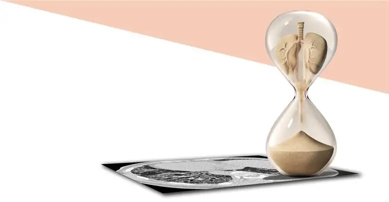 Имате съмнение за белодробна фиброза